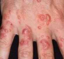 Actinic dermatitis: uzroci, simptomi, liječenje