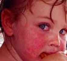 Alergičan na slatko u djece, u odraslih, liječenje