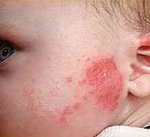Alergija u dojenčadi, uzroci, simptomi, liječenje