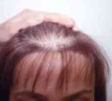 Androgene alopecije kod žena, simptoma, liječenje