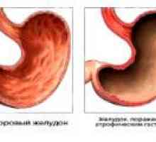Sekundarnom atrofični gastritis: uzroci, simptomi, liječenje