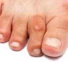 Artritis od prstiju i stopala, simptomi i tretman