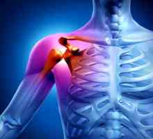 Artritis od ramenog zgloba: simptomi i tretman