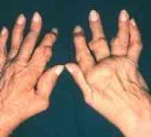 Artritis zglobova prstiju: Simptomi i liječenje