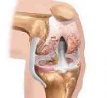 Osteoartritis koljena na stupanj 3: Liječenje