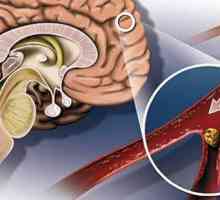 Moždani simptomi ateroskleroze i liječenje