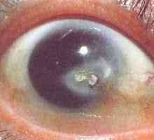Trn u oku: njezini uzroci, vrste i liječenje