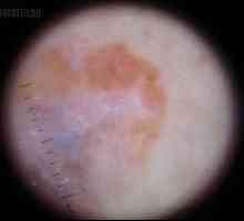 Amelanotic melanom: simptomi, uzroci prognoza