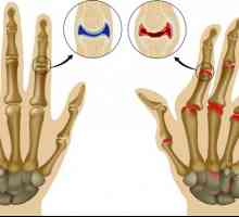 Biološko liječenje reumatoidnog artritisa: liječenje i lijekovi