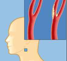 Plakova u krvnim žilama vratne kralježnice