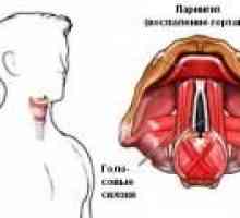 Grlobolja pri gutanju zbog laringitisa