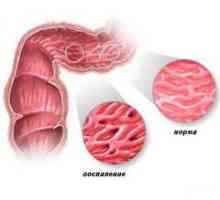 Crohnova bolest