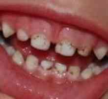 Što učiniti ako je vaše dijete plaka na zubima?
