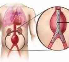 Što je aneurizma abdominalne aorte?