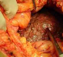 Ciroza jetre - glavni simptomi, vrste i liječenje tsiroz
