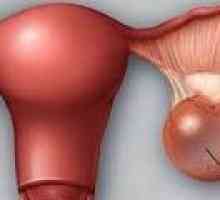 Cistadenom jajnika - uzroci, simptomi, liječenje