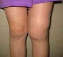 Deformacijom artroza koljena