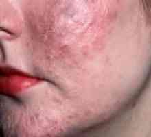 Acne Skin: uzroci, simptomi, liječenje