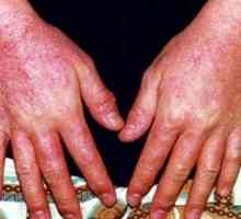 Dijagnoza i liječenje alergijskog dermatitisa