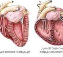 Dilatacijske kardiomiopatije, uzroci, simptomi, liječenje