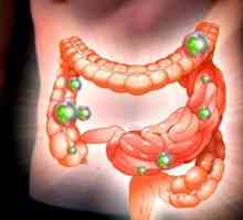 Crijevne dysbiosis: simptomi i tretman kod odraslih
