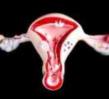 Disfunkcionalno krvarenje maternice: uzroci, liječenje