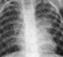 Diseminirane tuberkuloze: uzroci, simptomi, liječenje