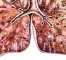 Diseminirane tuberculosis: simptoma, liječenje