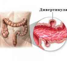 Diverticulosis crijeva (debelo crijevo) - simptomi i liječenje