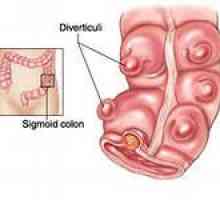 Divertikulitis - simptoma, liječenje, divertikulitisom u sigmoidnom debelom crijevu