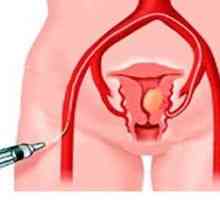 Uterine fibroids - Simptomi, dijagnoza, liječenje