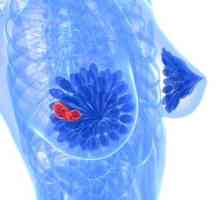 Fibrocističnu bolest dojke: simptomi