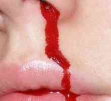 Krvarenje dijateza