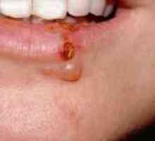 Herpes na usnama - uzroci, simptomi, liječenje