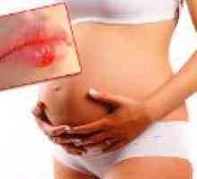 Herpes u trudnoći - da li je opasno?