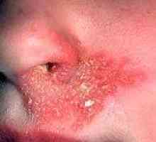Hladna čireve u nos, pod nosom: uzroci, liječenje
