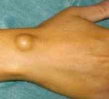 Hygroma zglob joint: uzroci i liječenje