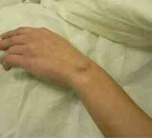 Hygroma zapešća, ruke, zglob - hygromas liječenje