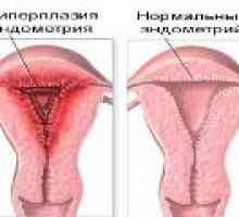 Liječenje hiperplazije endometrija menopauze