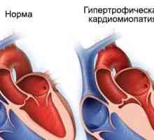 Hipertrofična kardiomiopatija, uzroci, simptomi, liječenje