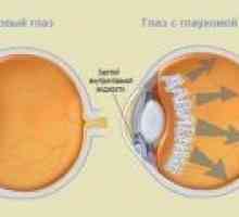 Glaukom - uzroci, simptomi, dijagnoza