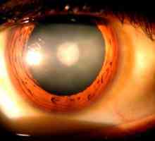 Očne tlaka: simptomi i liječenje