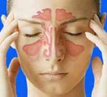 Gnojni sinusitis, uzroke, simptoma, liječenje