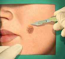Kirurški i lasersko uklanjanje melanoma