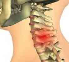 Chondrosis vratne kralježnice: uzroci, liječenje