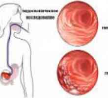 Kronični atrofični gastritis: uzroci, simptomi, liječenje