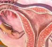 Kronični endometrija rak - uzroka, simptoma, liječenje