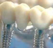 Zubni implantati: ključne činjenice