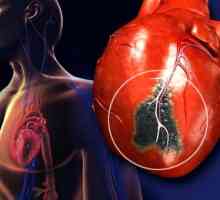 Srčani udar kod muškaraca i žena: simptomima i znakovima