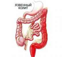 Ulcerozni kolitis